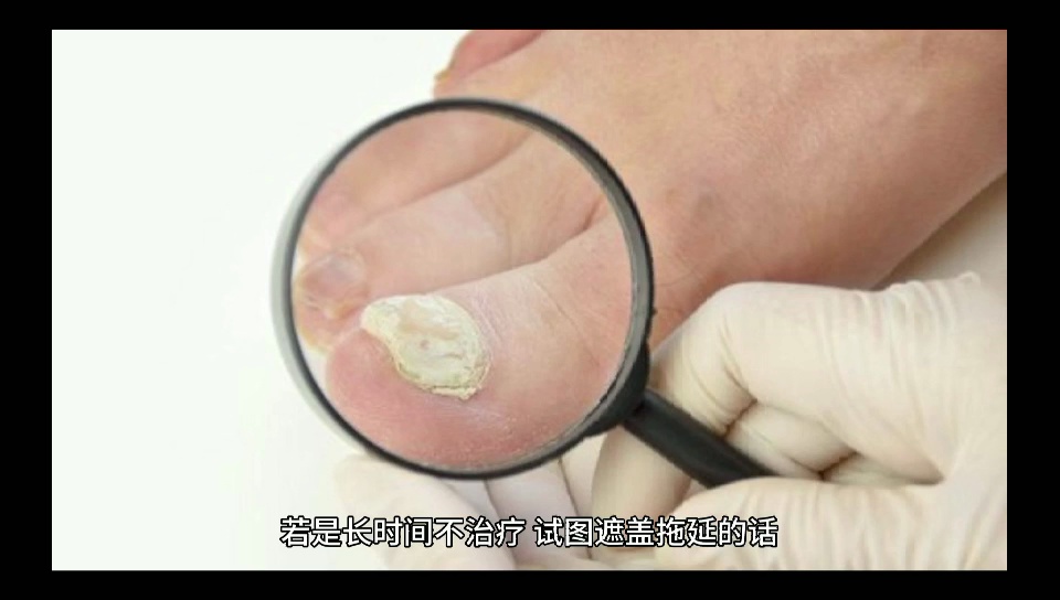 灰指甲长时间不治疗会有哪些影响