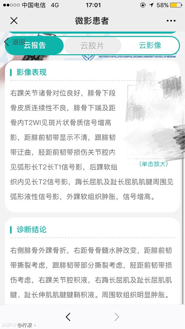 打球外脚踝骨折韧带撕裂 虎扑 打球外脚踝骨折韧带撕裂 虎扑