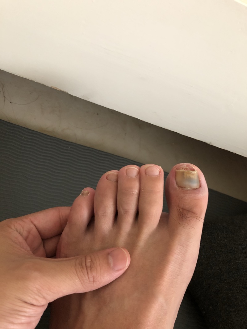 请问家人们 我在打篮球时候突破过猛 导致大拇指指甲脱落一半怎么办 虎扑