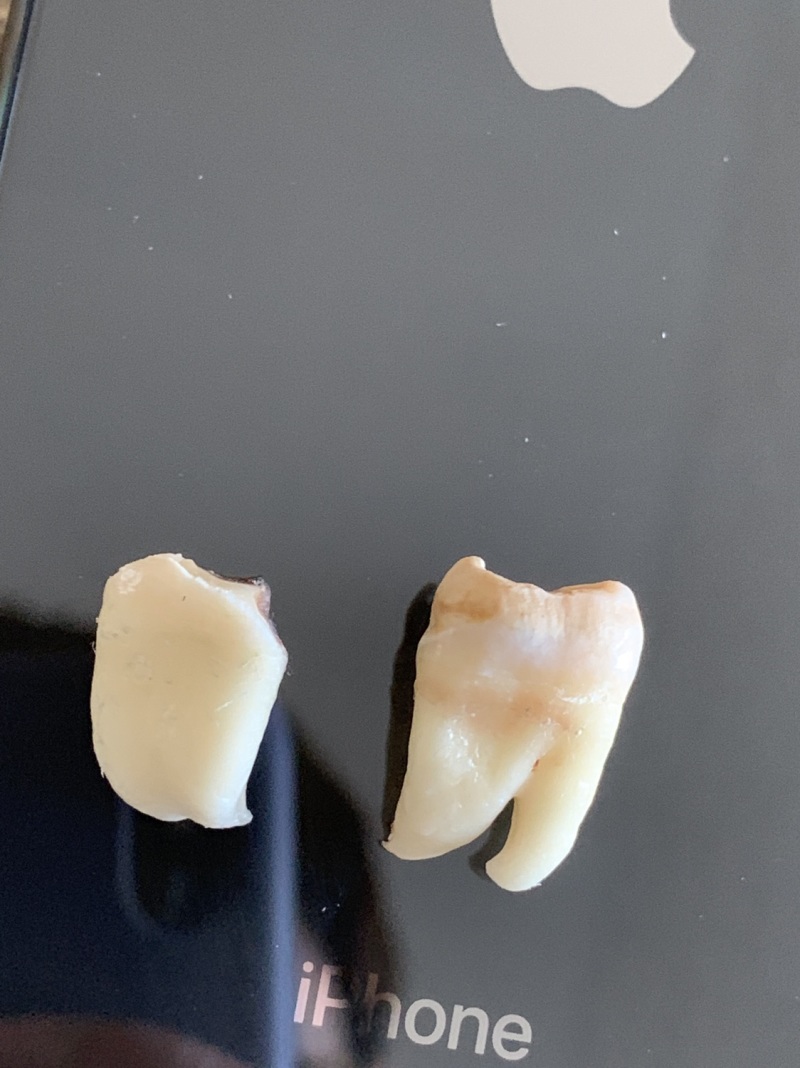 昨天拔的智齿什么水平.怕恶心别进来