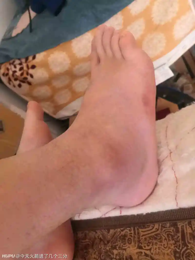 各位jr 脚踝韧带损伤一般多久能正常下地行走 健身和运动健康 虎扑社区
