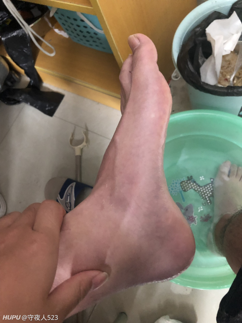 学院里面打比赛把脚崴了,请教各位老哥最快能几天恢复.