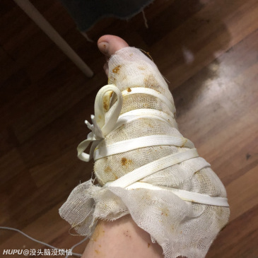 崴脚后你们都用什么药物?