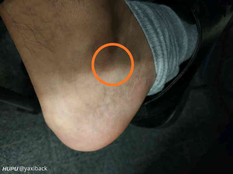 脚踝内存长期疼痛,求相似经历或神医