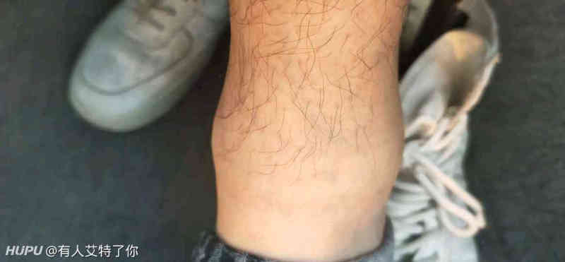 脚崴了半年还是肿的 运动就痛 虎扑