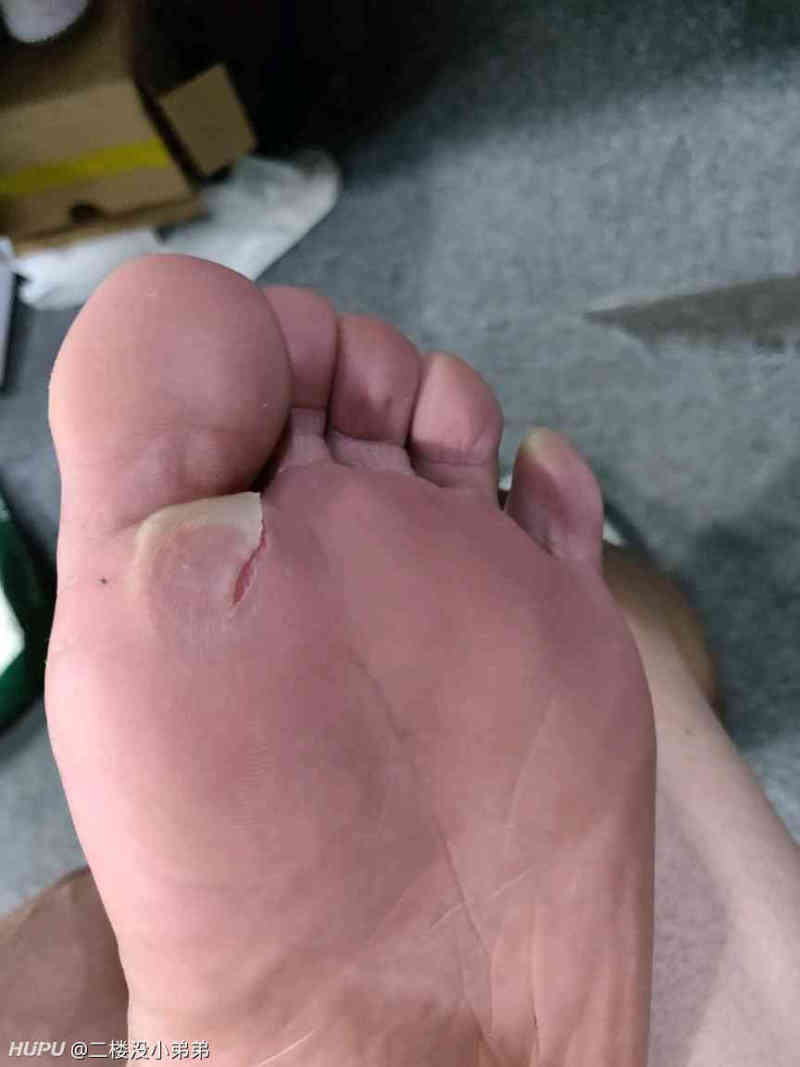 脚底破皮了,怎么样才能快速恢复?
