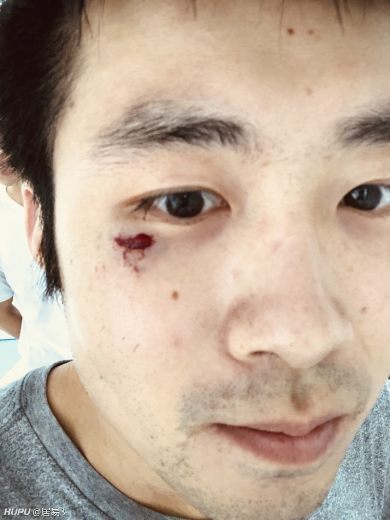 我和范乔丹一样被撞破脸,会破相吗?