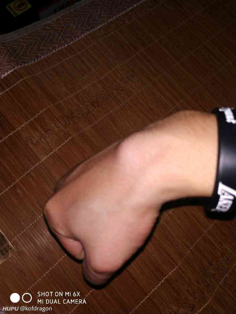 无意发现手腕处肿了一个包 虎扑