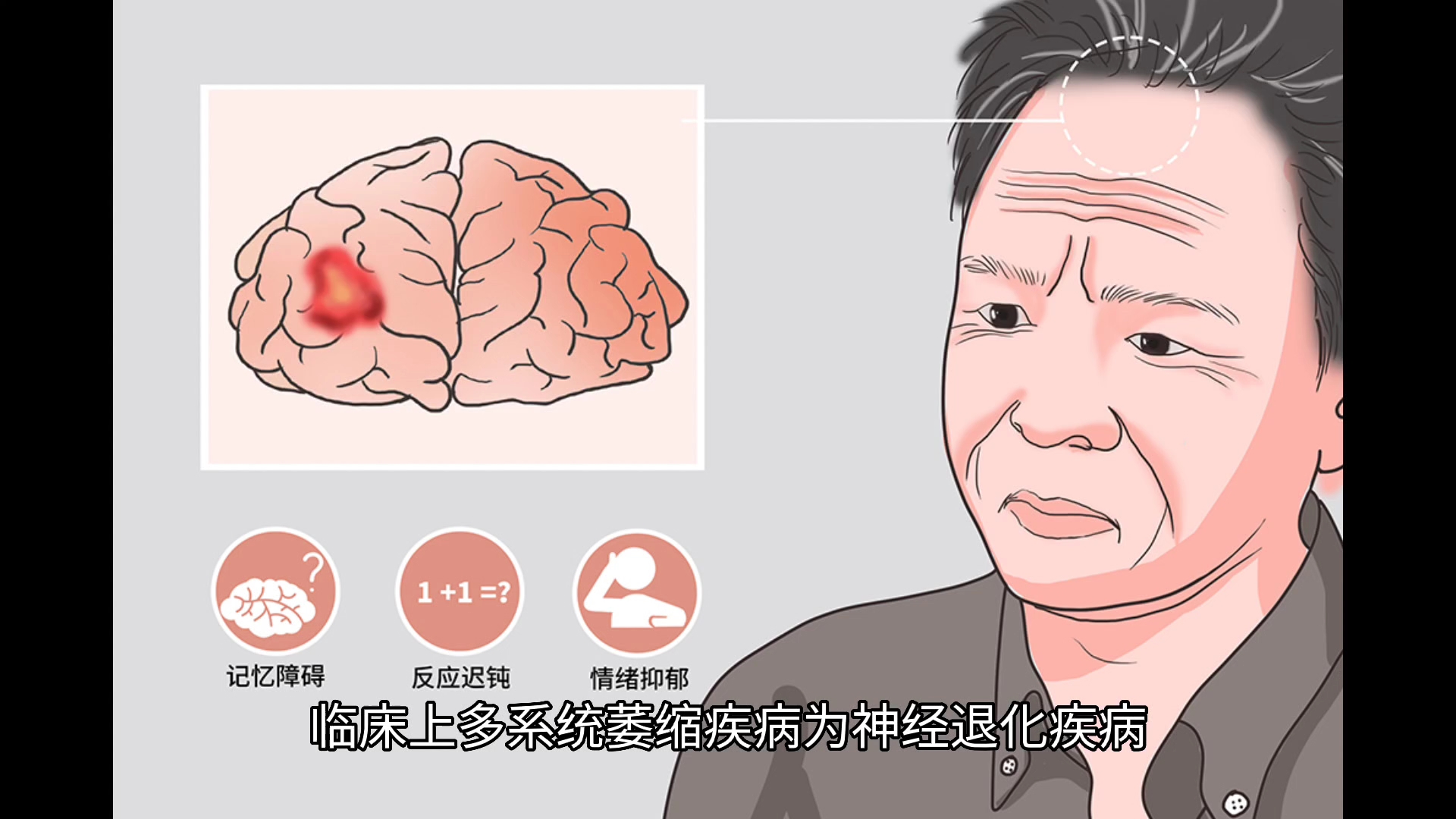 多系统萎缩是什么意思