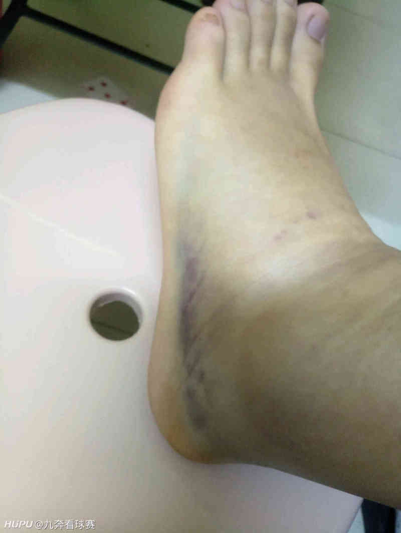 一年之内,打篮球左右脚两次严重崴脚!