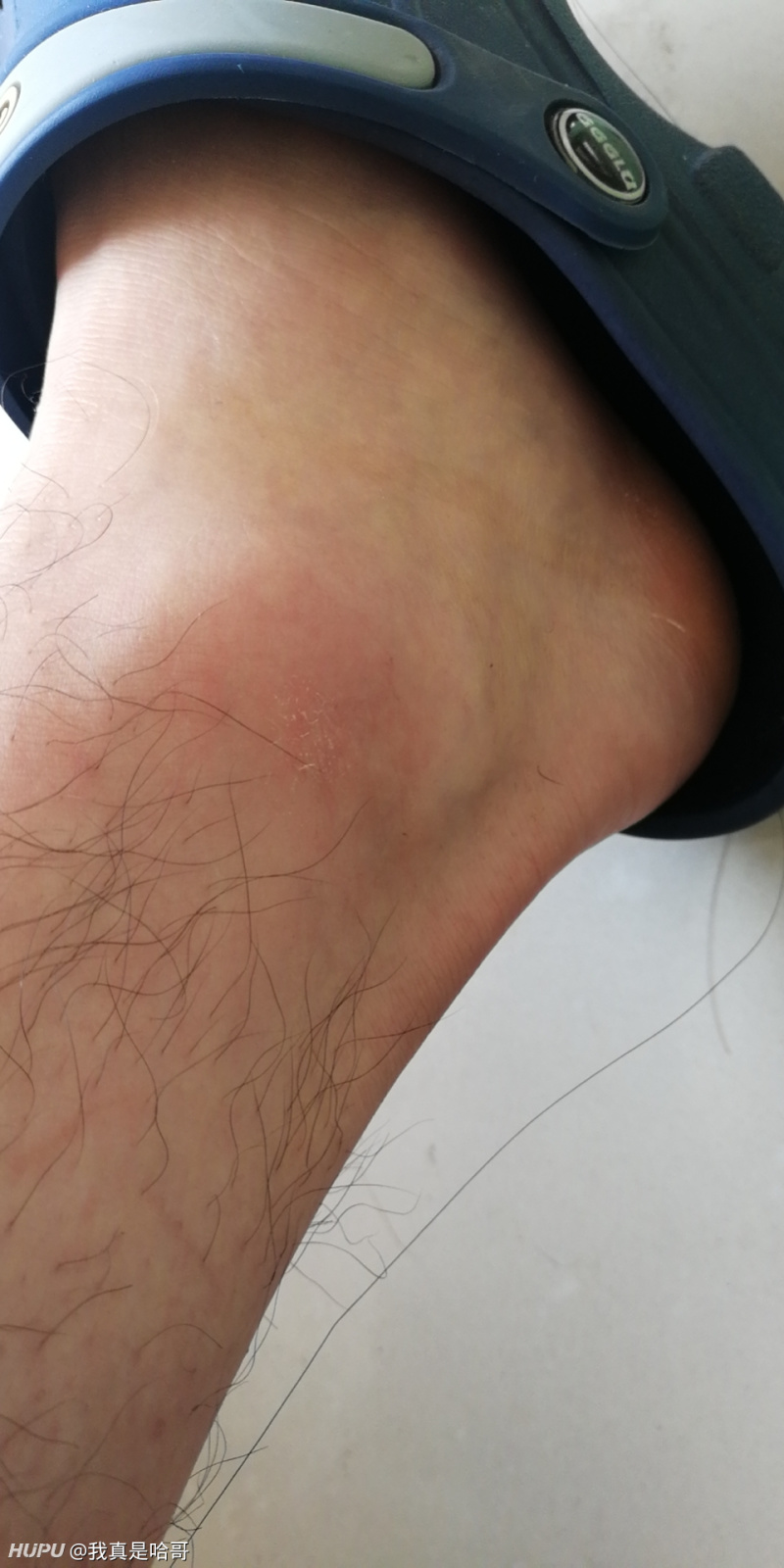 昨天打球崴脚了,这情况多久能打球